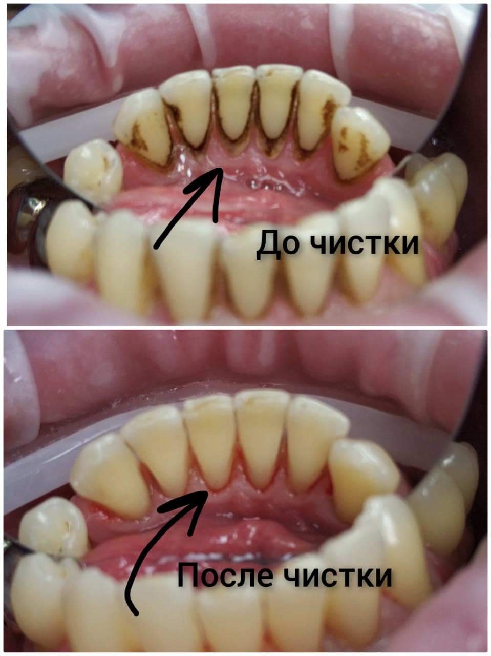 Ультразвуковая чистка зубов в Красноярске