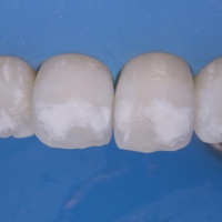 Флюороз зубов