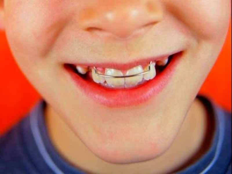 Способы выравнивания зубов у детей
