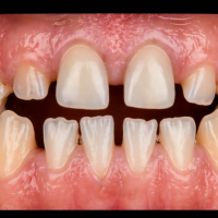 Маленькие зубы: причины микродентии и способы коррекции