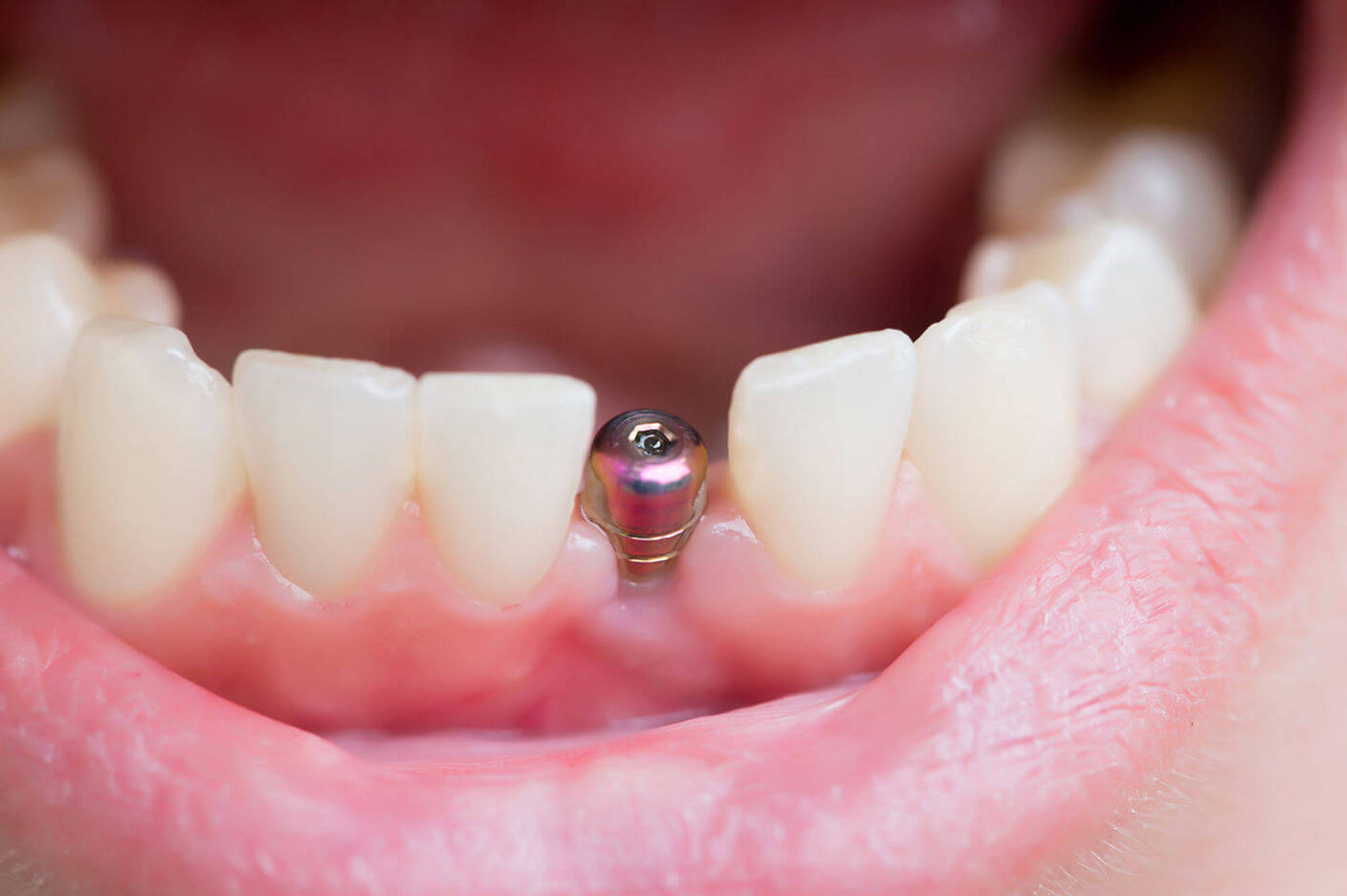 отторжение зубного импланта
