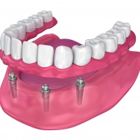 стоматологический абатмент