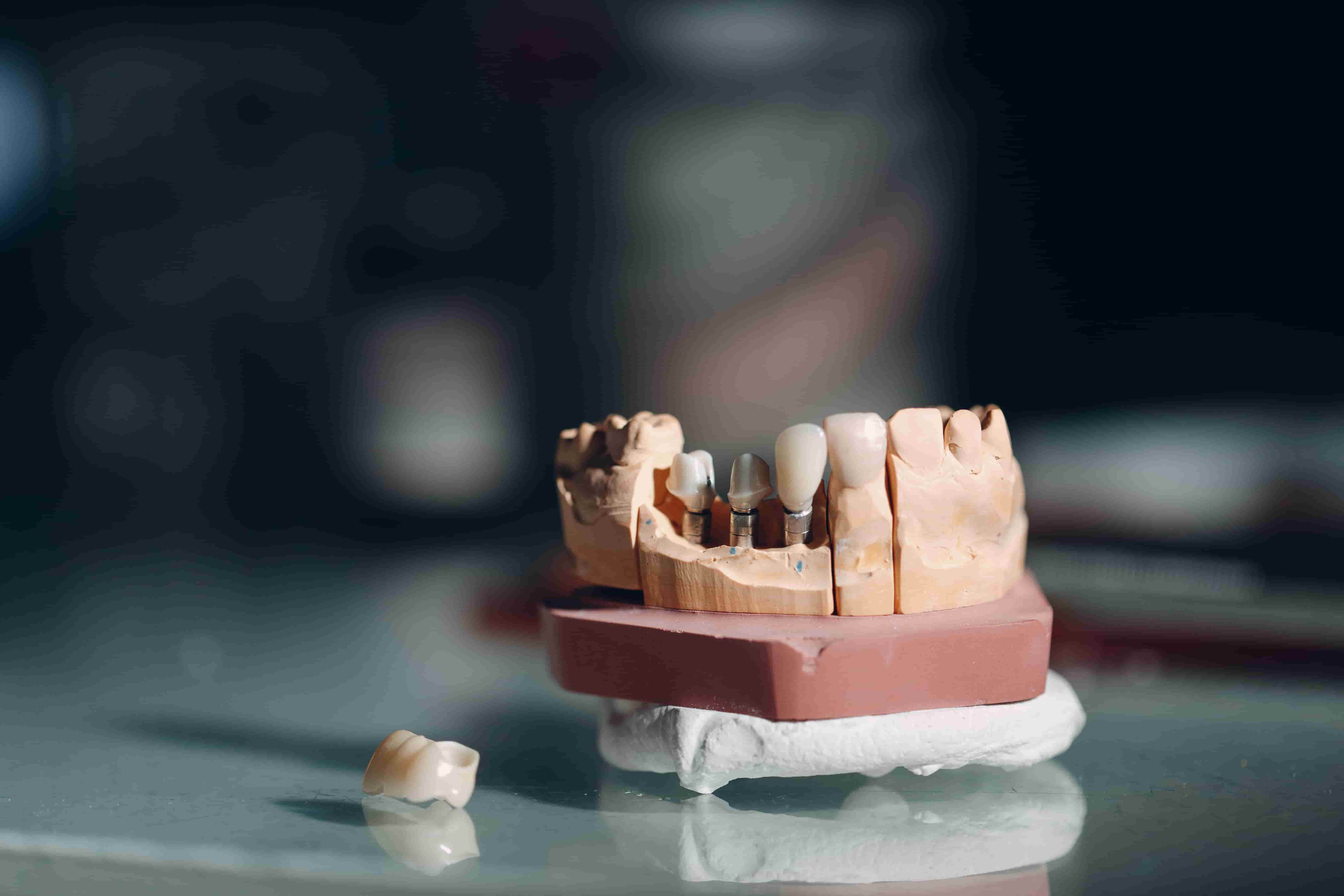 виды протезирования зубов