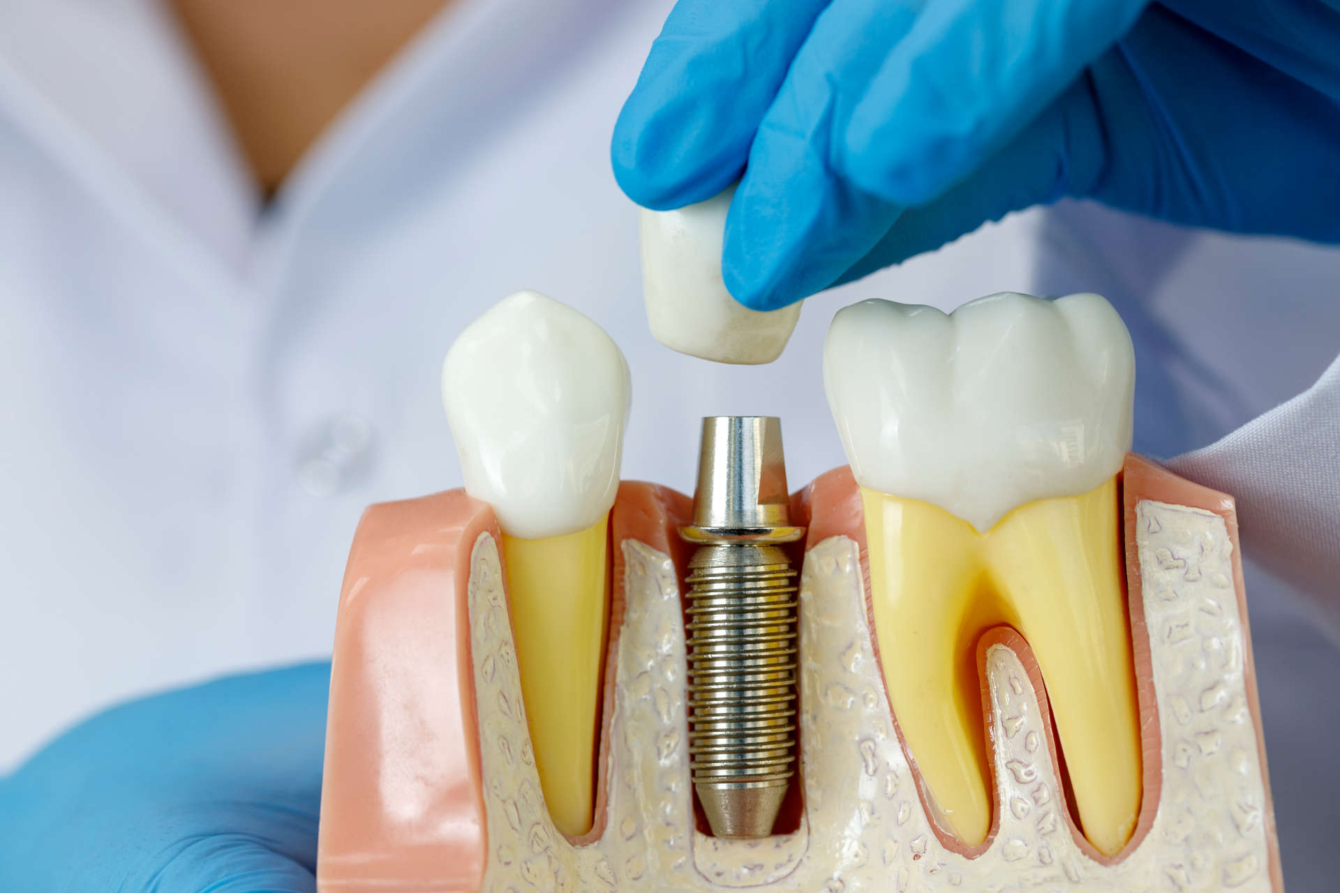 Как избежать осложнений после имплантации зубов?
