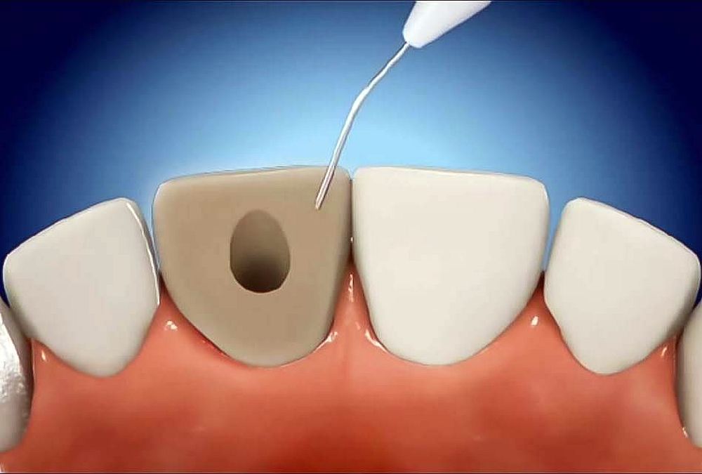 внутриканальное отбеливание зубов
