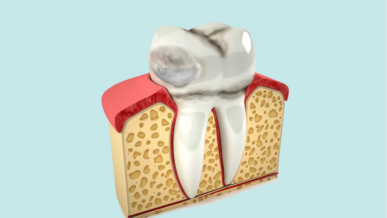 эрозия зубов