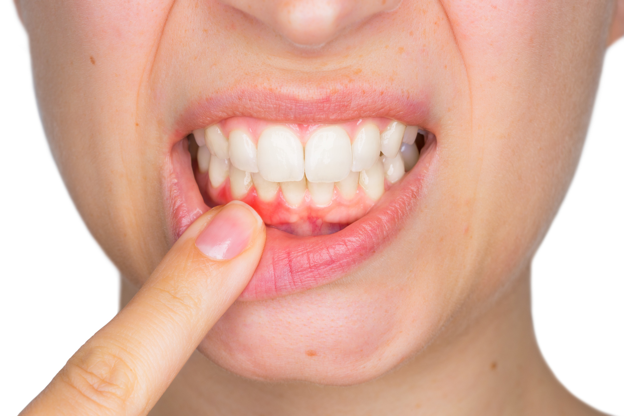 Может ли возникнуть аллергия на зубные коронки?