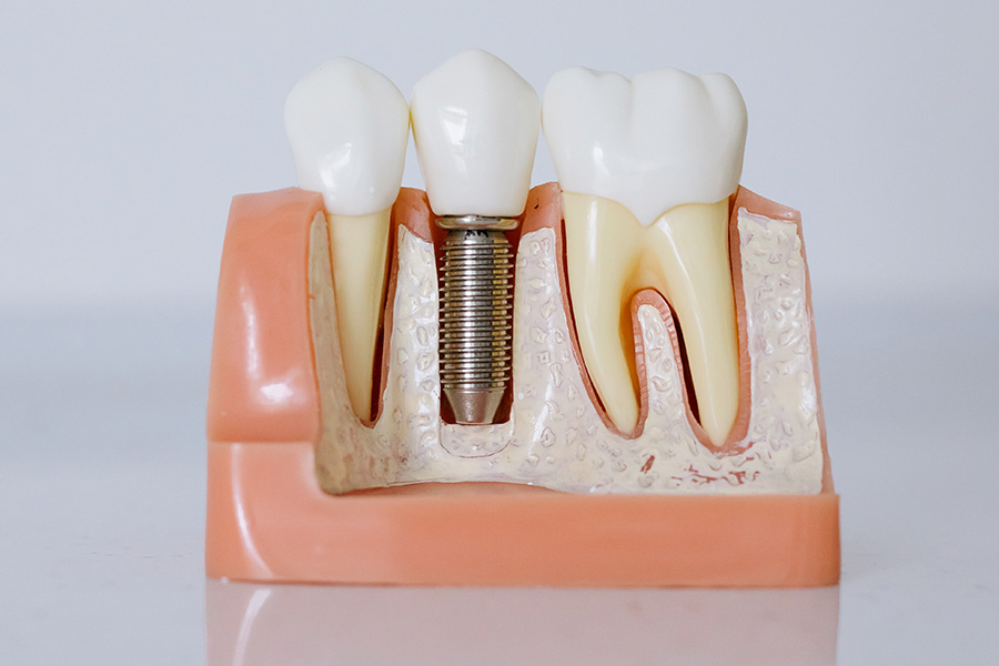 Что нужно знать перед имплантацией зубов