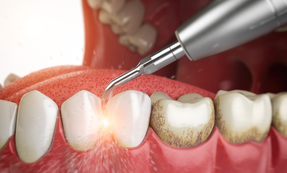 Почему образуется зубной налет и как его удалить?