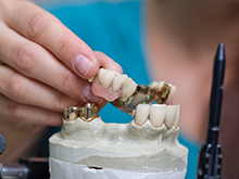 протезирование зубов, вставить зубы