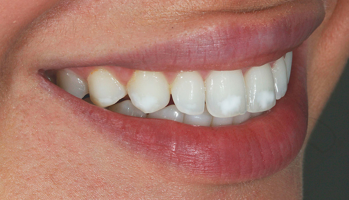 Причины появления белых пятен на зубах